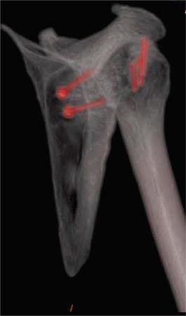 Fig. 43.13, Postoperative computed tomography image demonstrating screw fixation into the glenoid and humerus with anatomic reconstruction of the shoulder joint.