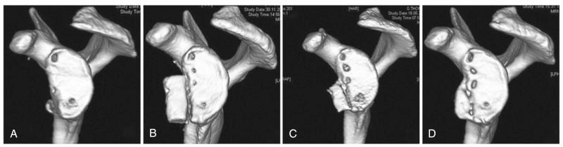 Fig. 43.14, Three-dimensional computed tomography images demonstrating glenoid bone loss (A), placement of graft (B), and progression of integration/osteolysis of the graft (C and D).