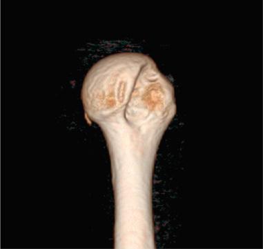 Fig. 43.2, A humeral head with Hill-Sachs lesion is shown here. Preoperative three-dimensional computed tomography imaging of the humeral head may help to guide the treatment plan. It is important to quantify bone loss and to determine location in relation to the glenoid track.