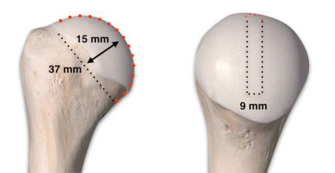 Fig. 43.4, Assessment of Hill-Sachs lesions begins with determining the dimensions of the humeral head, then determining the location and size of the humeral head defect. The risk of engagement can be determined using glenoid tract measurements.