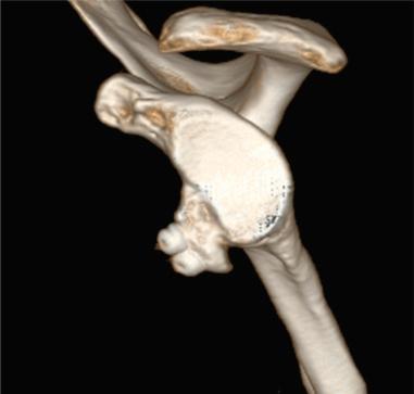 Fig. 43.6, Sagittal oblique three-dimensional computed tomography image following failed Latarjet bony reconstruction.