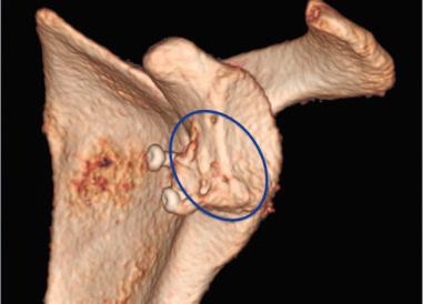 Fig. 43.7, Three-dimensional computed tomography image demonstrating fixation of a coracoid graft placed at the anteroinferior glenoid rim. Proper, medial position of the coracoid is highlighted. Some resorption is also evident.