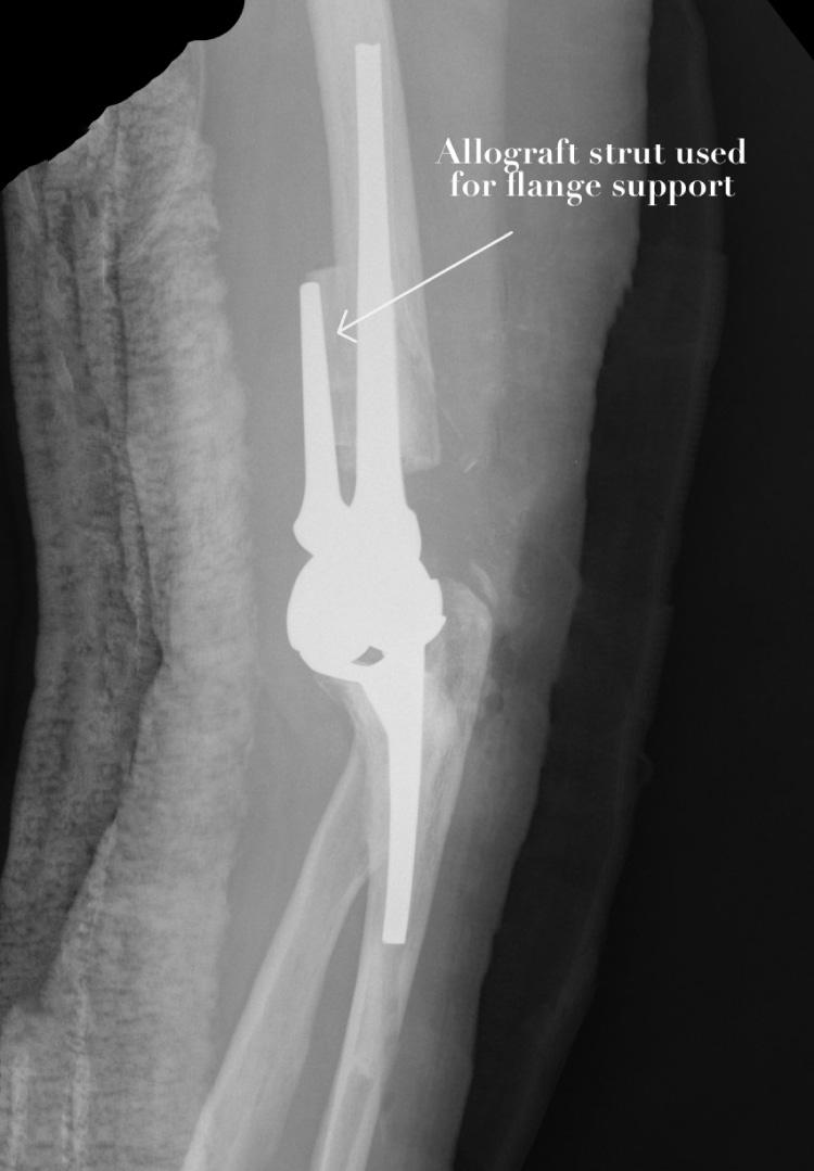 FIG 107.1, Cortical struts are particularly useful in the elbow to support the anterior flange of the humeral component in revision surgery.