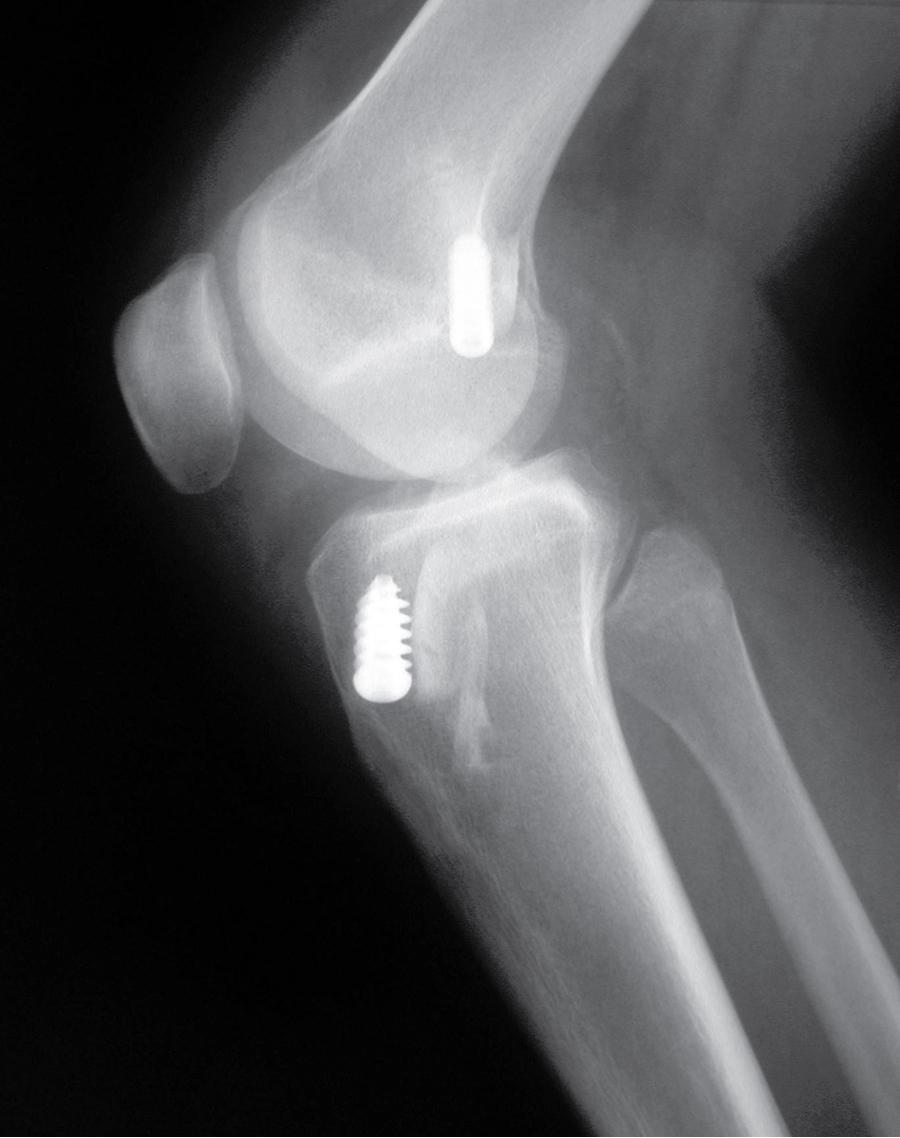 Fig. 84.1, Vertical femoral tunnel.