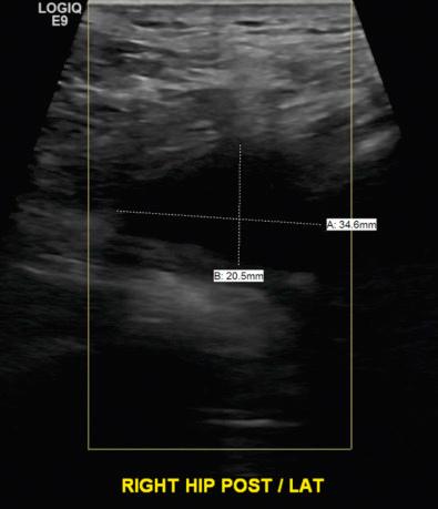 Fig. 104.1, Ultrasound image from the posterior and lateral aspect of the right hip in a patient with metal-on-metal total hip arthroplasty and evidence of an adverse local tissue reaction. This image demonstrates a 20.5 mm × 34.6 mm hypoechoic lesion.