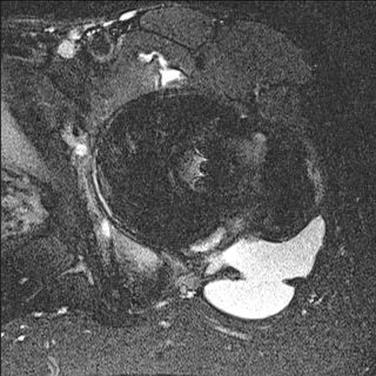 Fig. 104.2, Axial magnetic resonance imaging Short-TI Inversion Recovery demonstrating fluid collection around the joint.