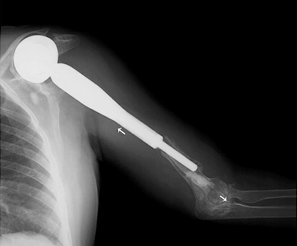 FIG 109.1, Efforts to restore function, even in the face of massive bone loss, requires what we consider salvage options. The allograft prosthetic replacement appears to be the best option at this time.