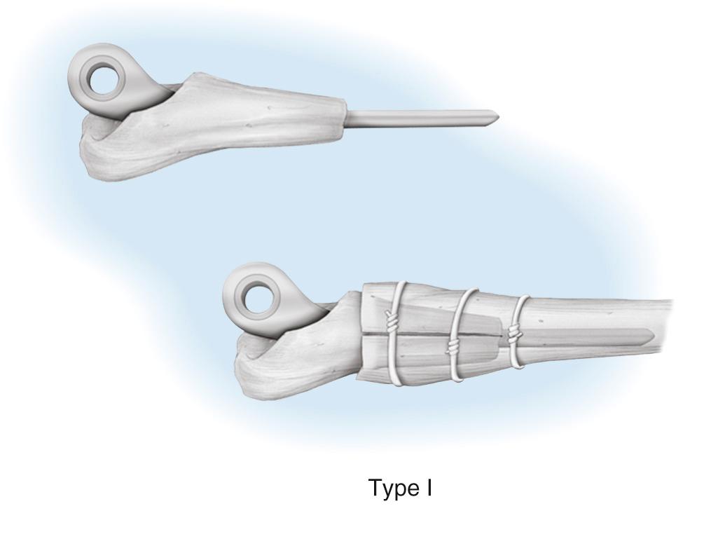 FIG 109.5, The type I composite is a circumferential graft that is “intussipated” into the host. Careful orientation is required, and cerclage fixation collapses the host onto the graft.