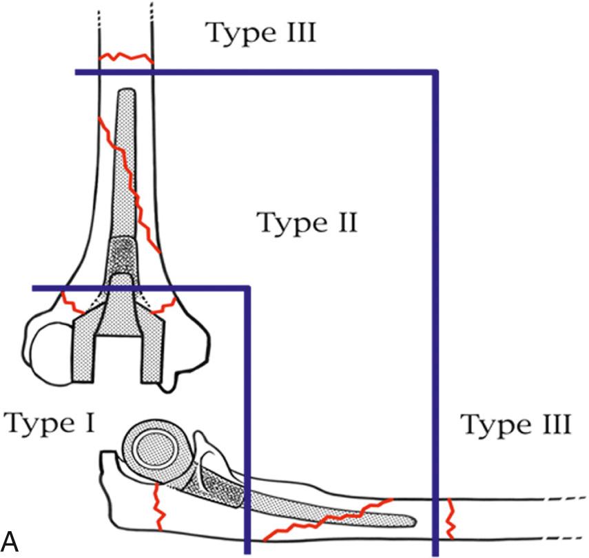 FIG 108.2, (A,B) Fracture associated with expansive osteolysis is typically at the tip of the implant, a Mayo type III fracture.