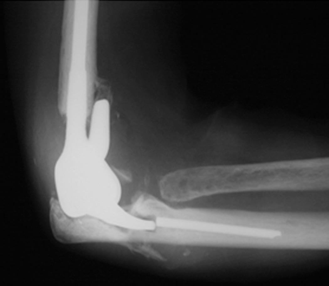 FIG 106.1, Fracture of Coonrad-Morrey ulnar component in a patient who repeatedly lifted more than 50 pounds. Note well-fixed stem.