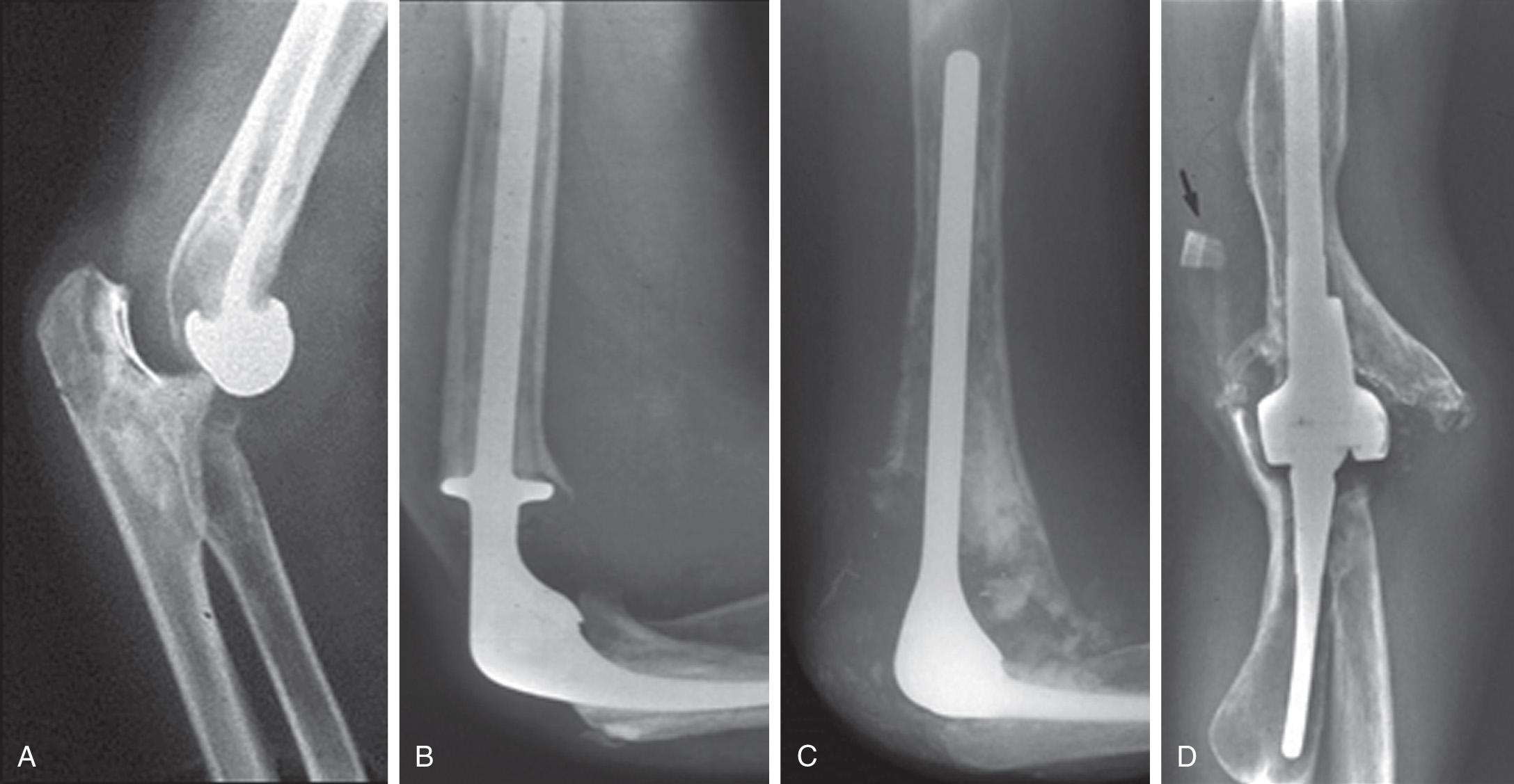 FIG 106.5, The effectiveness is dependent on the quality of the bone that is present. (A) Excellent bone with short stems. (B,C) Osseous expansion and cortical thinning require some form of bone augmentation. (D) Gross resorption of both humerus and ulna deficiencies must be address for a successful revision.