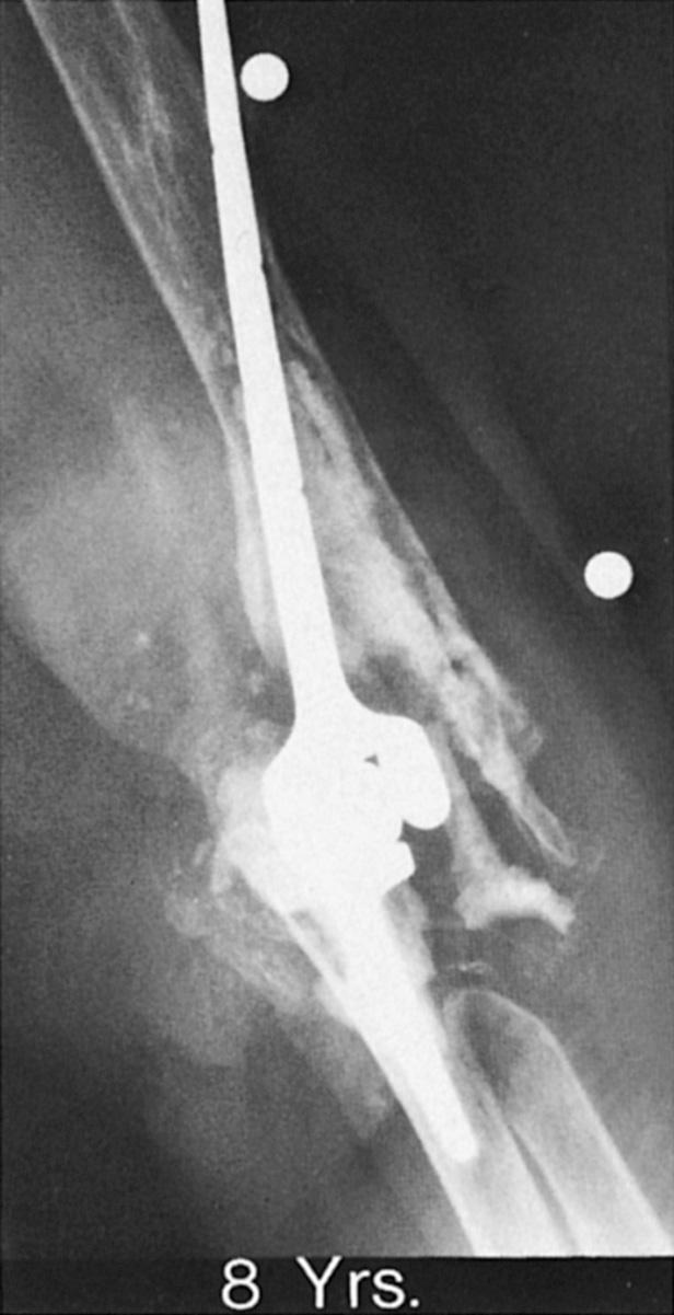 FIG 106.7, Because the grossly loose Pritchard-Walker II implant was not painful, revision was deferred, resulting in gross osteolysis.