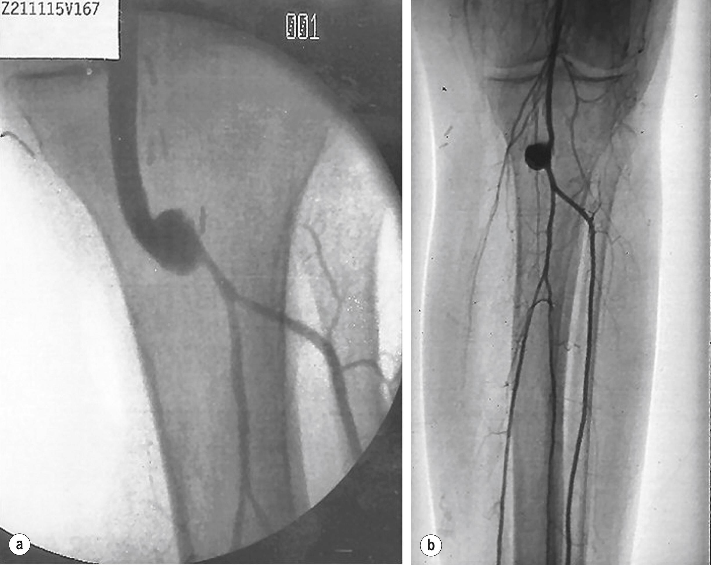 Figure 7.1, (a ) Femoropopliteal bypass with venous cuff (Miller cuff) at the distal anastomosis. Perioperative angiography. (b) Preservation of outflow vessels after thrombosis at 3 years.