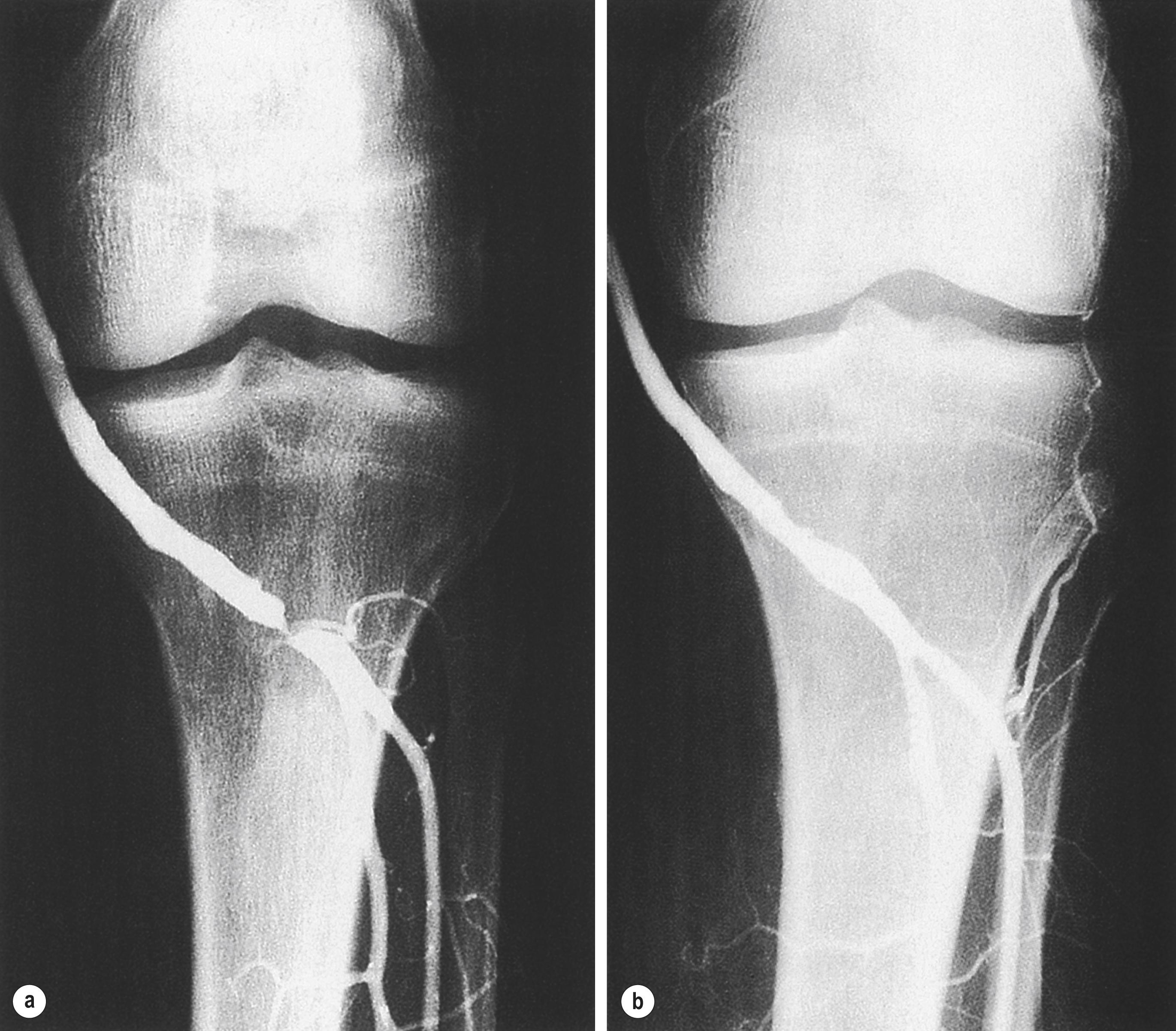 Figure 7.2, Vein graft stenosis near the below-knee popliteal anastomosis (a) successfully treated by balloon angioplasty (b) .