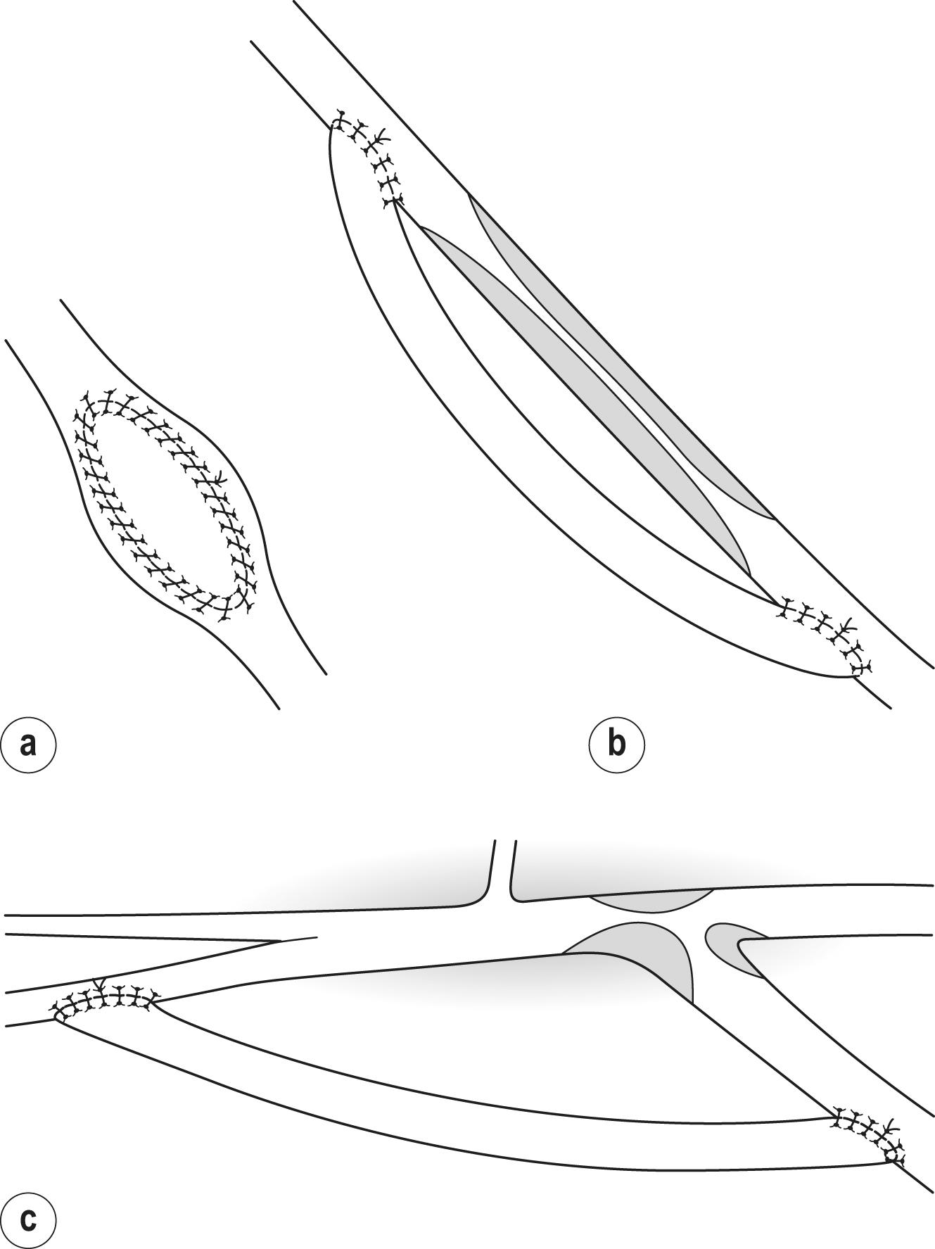 Figure 7.3, (a) Vein patch angioplasty, (b) bypass of long vein graft stenosis and (c) jump graft around stenosed distal anastomosis of a femoropopliteal bypass graft to the popliteal artery.