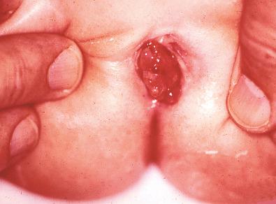 Fig. 19.14, Botryoid rhabdomyosarcoma arising in vagina of child.