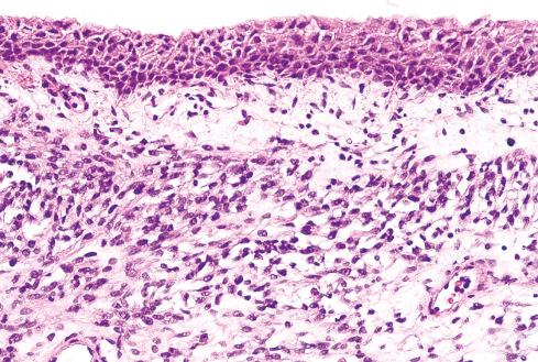 Fig. 19.18, Botryoid rhabdomyosarcoma showing the characteristic “cambium” layer of cells. Submucosal in location, the cells are condensed beneath a zone of loose stroma.