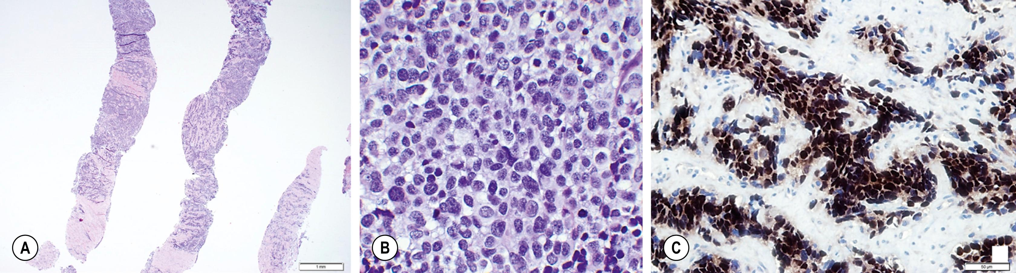 Fig. 69.2, Alveolar rhabdomyosarcoma. Needle core biopsy sample from a soft tissue arm mass from a teenage girl (A) . A highly cellular “small, round blue cell neoplasm” is seen infiltrating the connective tissue in skeletal muscle (H&E stain). (B) At high power, tumor cells are tightly packed, with variably molding cell membranes, small to moderate amount of delicate cytoplasm, relatively uniform round nuclei, delicate to “salt-and-pepper” chromatin, mostly inconspicuous nucleoli, and scattered mitoses (H&E stain). (C) Immunohistochemical stain for myogenin strongly highlights the nuclei of the overwhelming majority of infiltrating densely packed tumor cells. In contrast, nuclei of the collagenous connective tissue in the background remain appropriately negative.