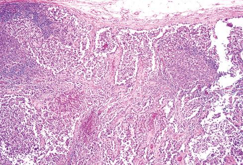 Fig. 19.27, Metastatic alveolar rhabdomyosarcoma to a lymph node. The alveolar pattern is present in the metastasis as well.