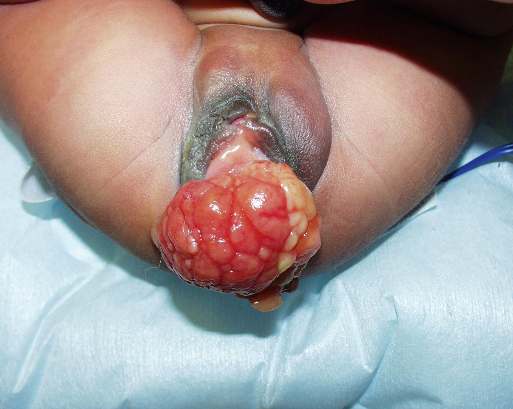 Fig. 69.3, This neonate was born with this mass protruding from her vagina. Biopsy of the mass showed rhabdomyosarcoma. She underwent chemotherapy and has recovered uneventfully. Rhabdomyosarcoma of the vagina has been termed sarcoma botryoides.