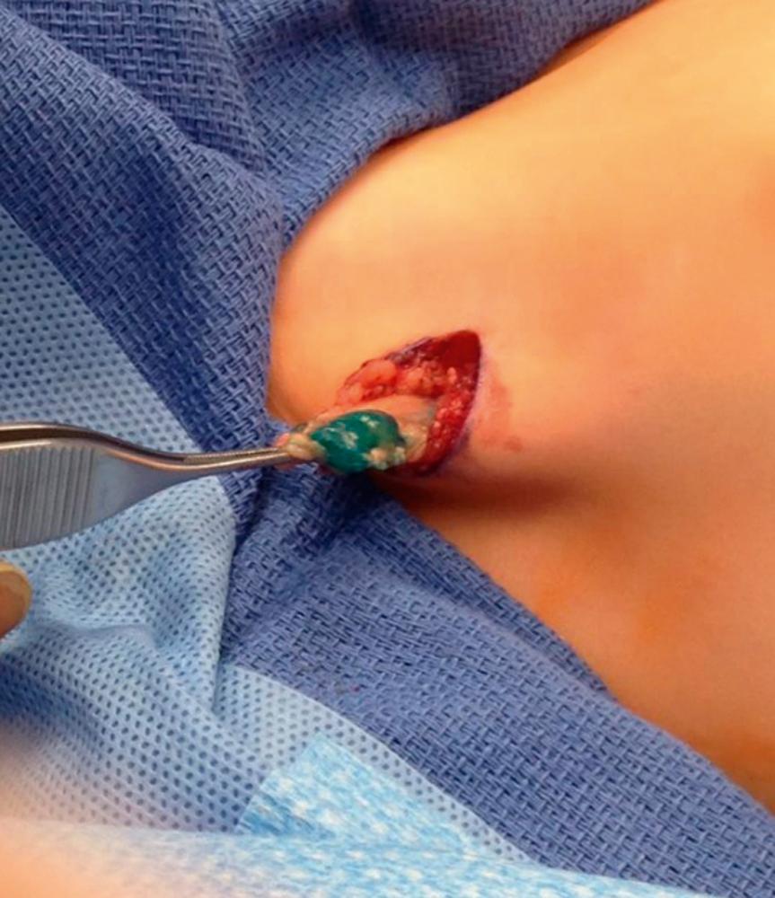 Fig. 69.4, Axillary sentinel lymph node biopsy from a child with a trunk rhabdomyosarcoma. Blue dye can be appreciated in the sample. The arm is extended to the left under the sterile towels.