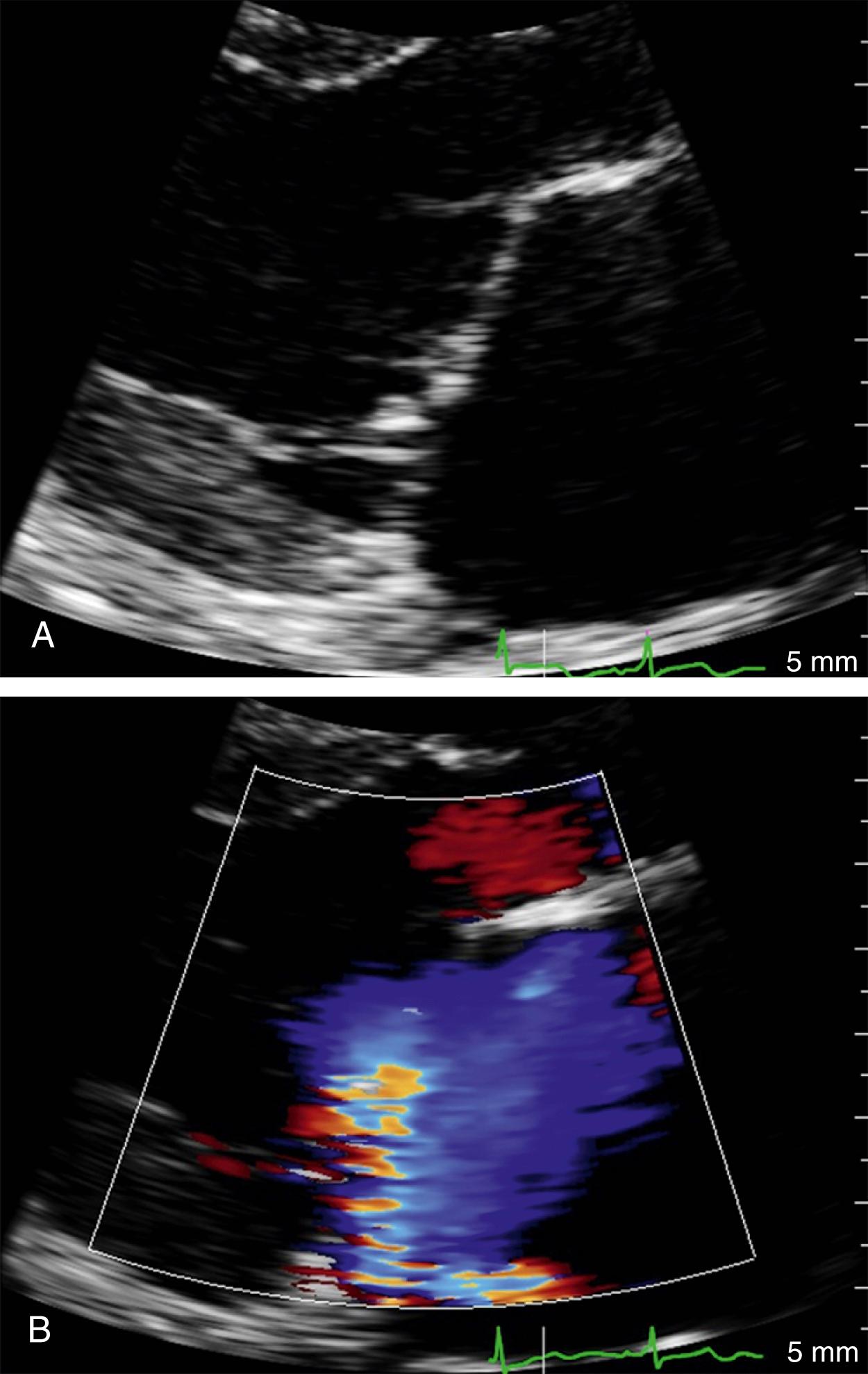 Figure 149.2, A, Left parasternal view demonstrating prolapse of the anterior leaflet of the mitral valve, with failure of coaptation of the anterior and posterior leaflet tips. B, Left parasternal view demonstrating an eccentric jet of mitral regurgitation caused by prolapse of the anterior leaflet.