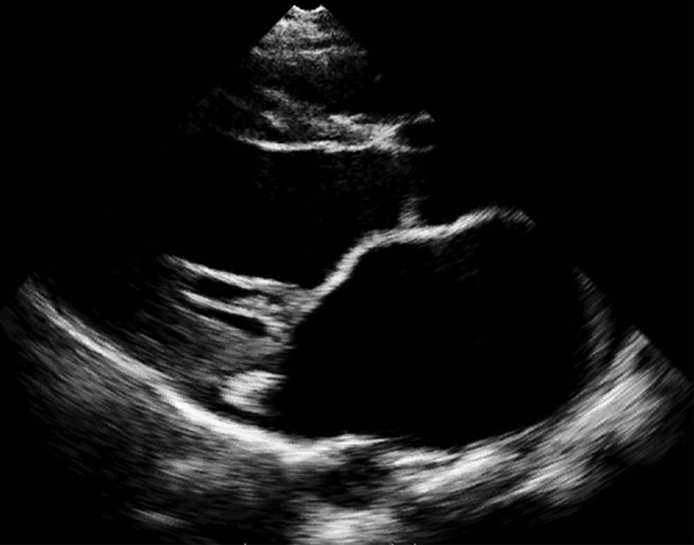 Figure 149.3, Left parasternal view demonstrating the prolapse of the anterior leaflet with prominent thickened chordae attached to both leaflets.