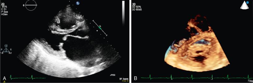 Fig. 16.1, Severe Mitral Stenosis.