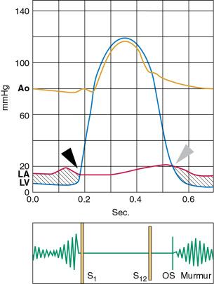 Fig. 16.2, Correspondence Between Hemodynamics and Auscultation of Mitral Stenosis.