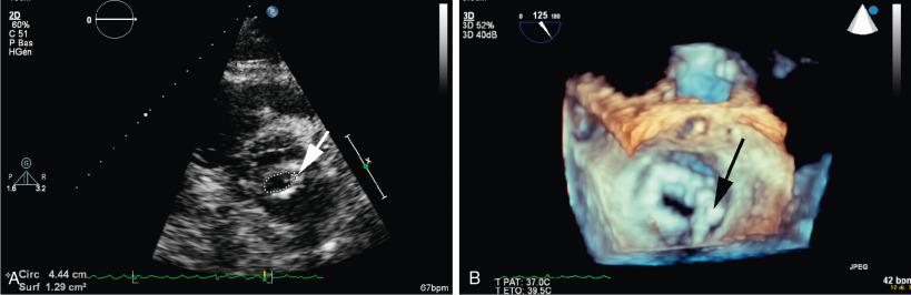 Fig. 16.3, Mitral Stenosis With Calcification of the Lateral Commissure.