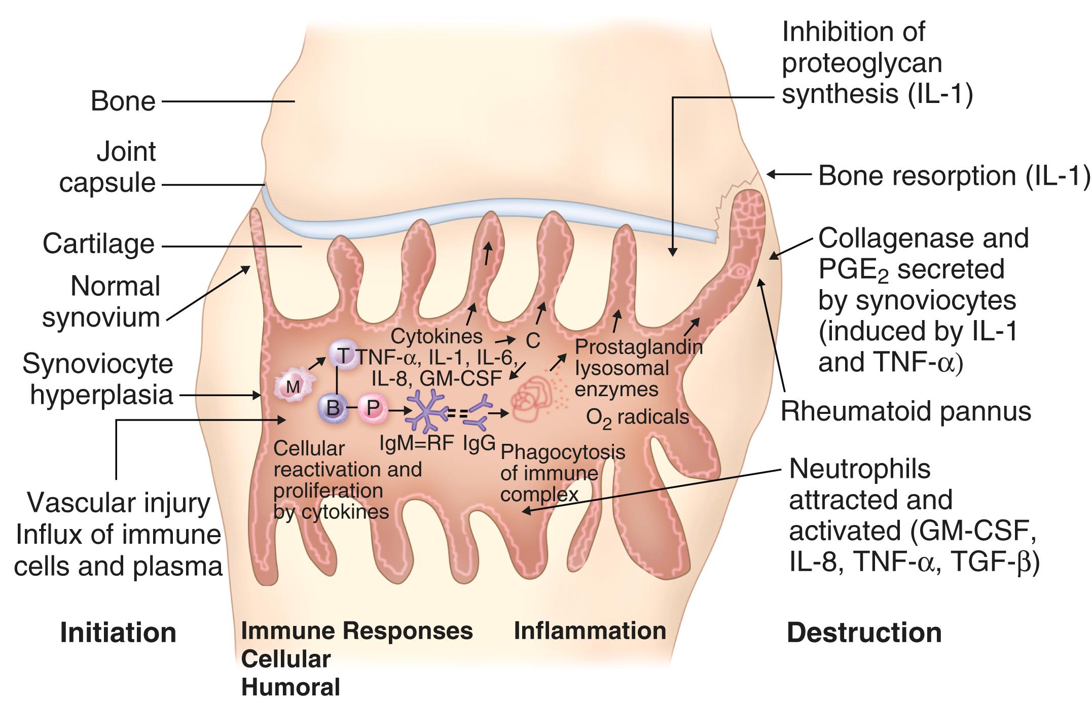 E-FIGURE 243-2, Events involved in the pathogenesis of rheumatoid synovitis (progressing from left to right ).