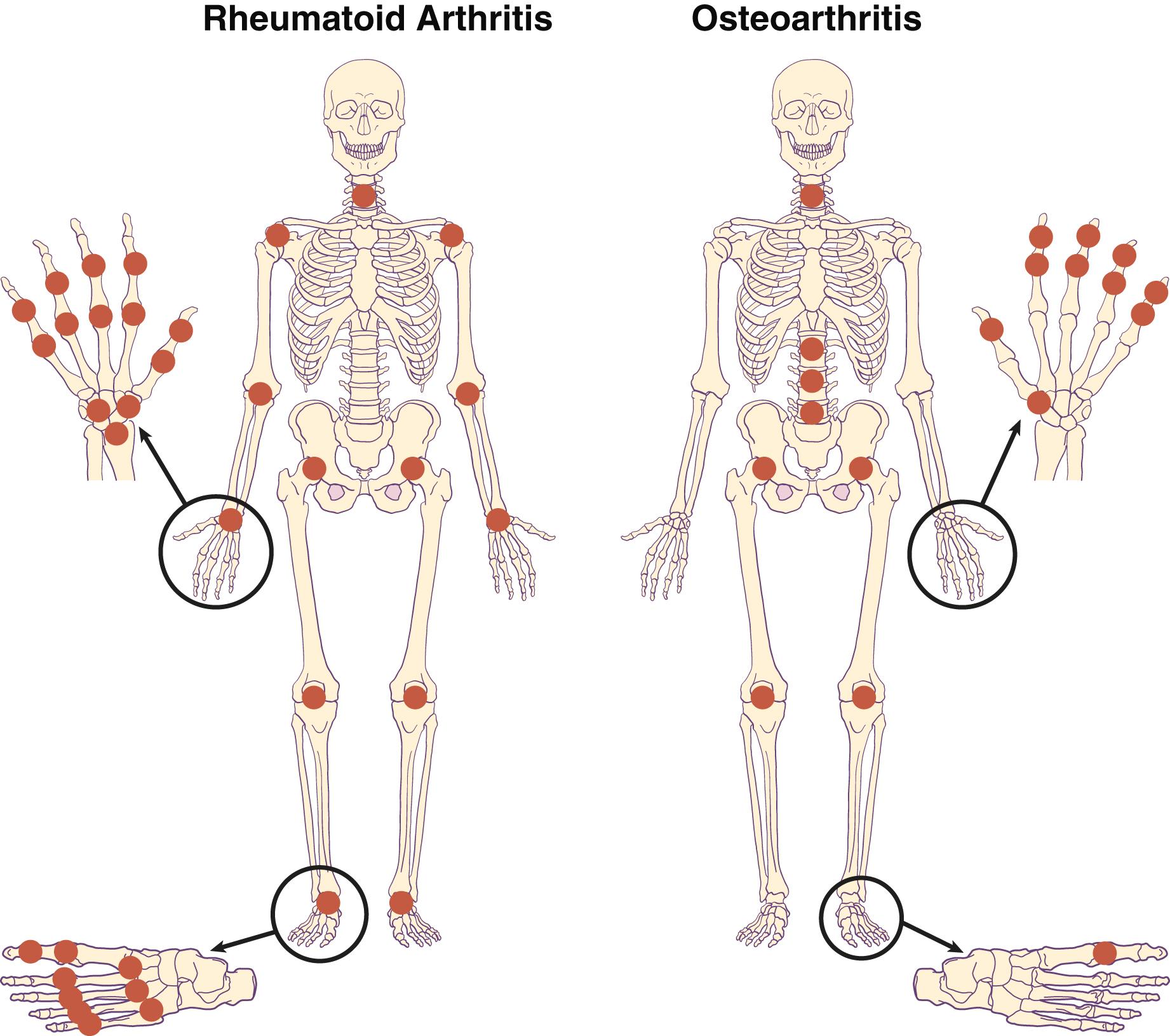 FIGURE 243-1, Distribution of involved joints in the two most common forms of arthritis: rheumatoid arthritis and osteoarthritis.