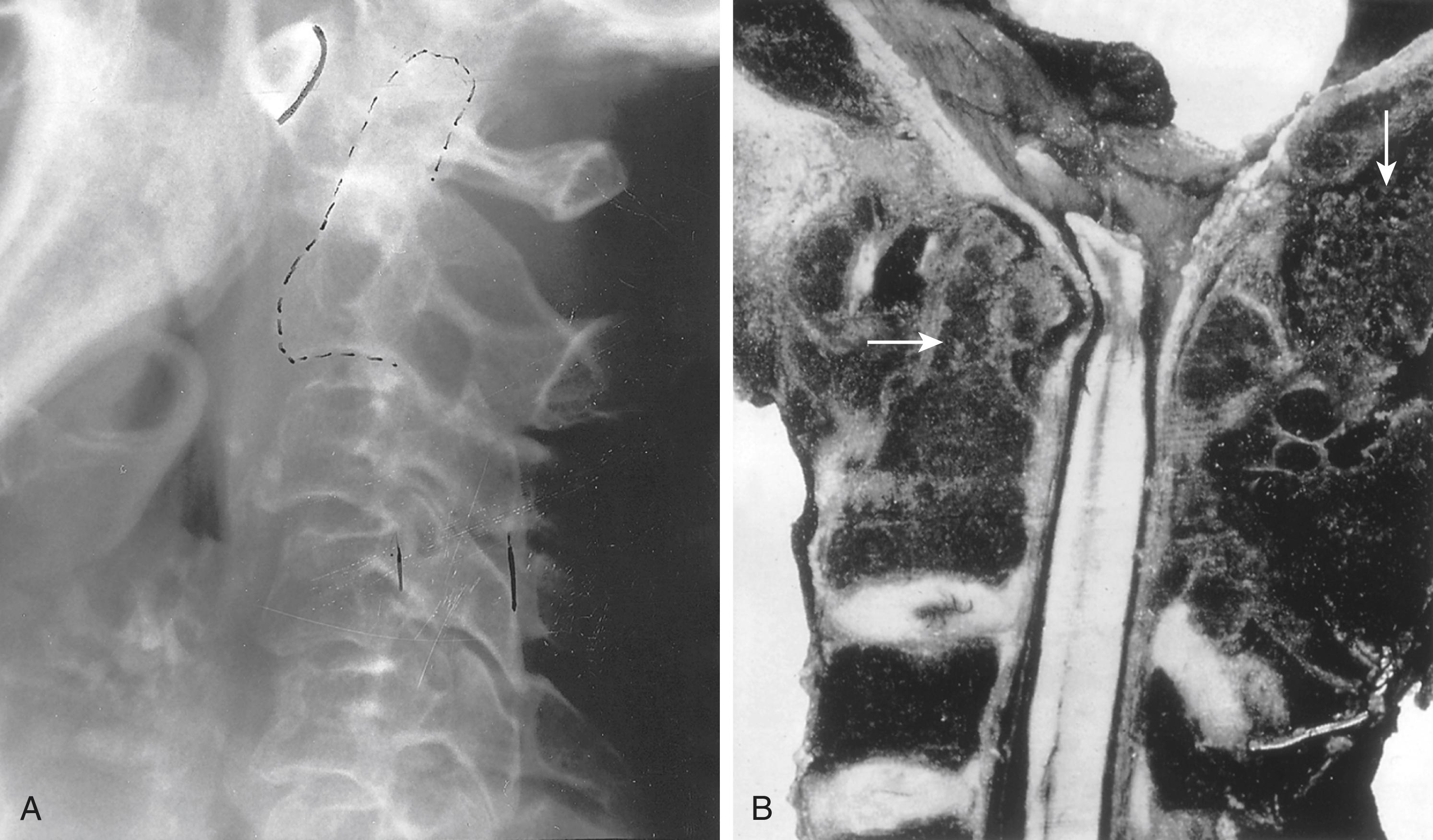 FIGURE 243-2, Subluxation of the cervical spine in patients with rheumatoid arthritis.