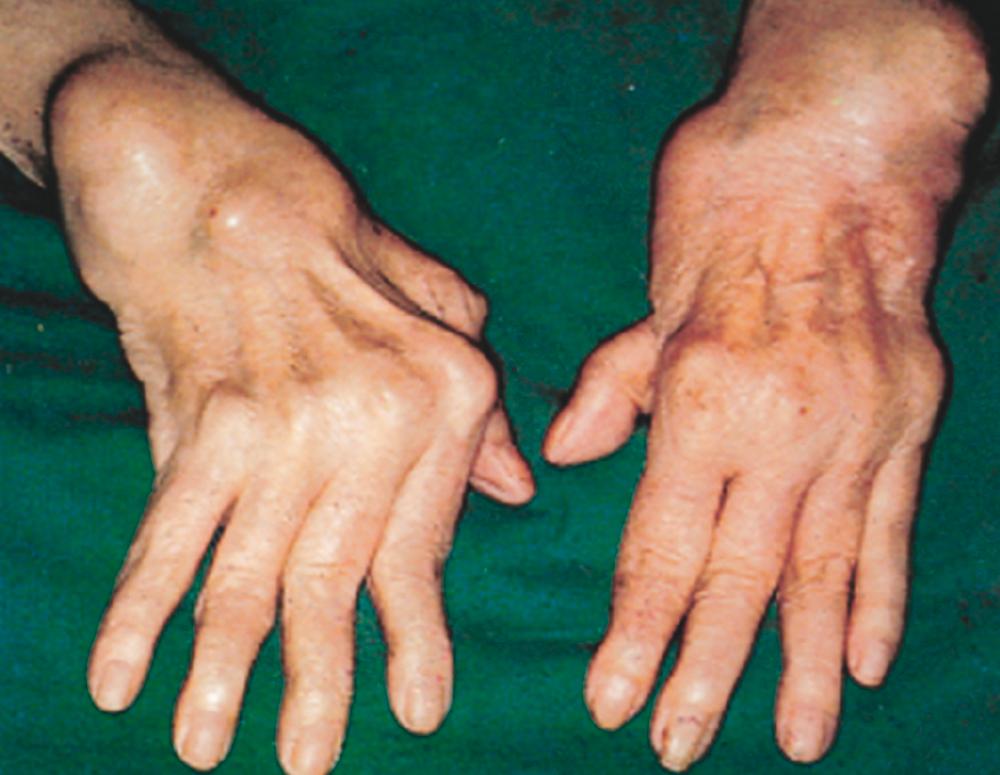 FIGURE 243-3, Severe advanced rheumatoid arthritis of the hands.