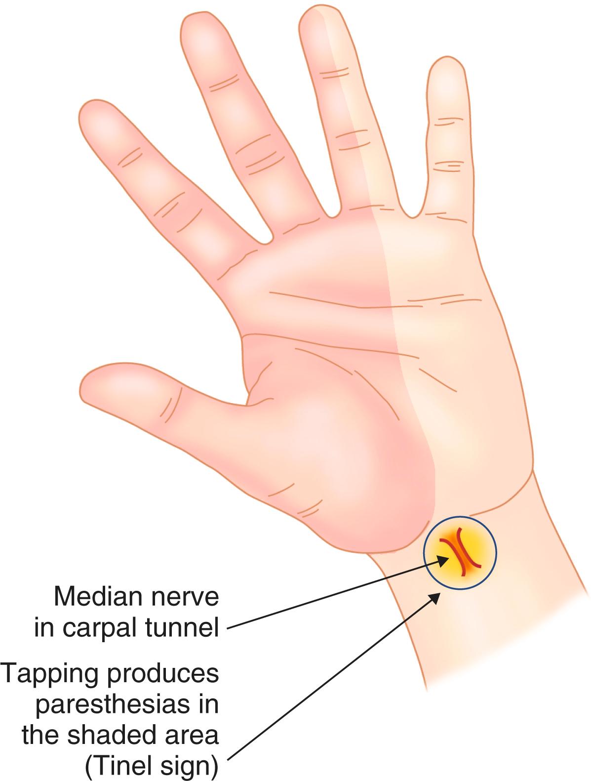 FIGURE 243-4, Carpal tunnel syndrome.