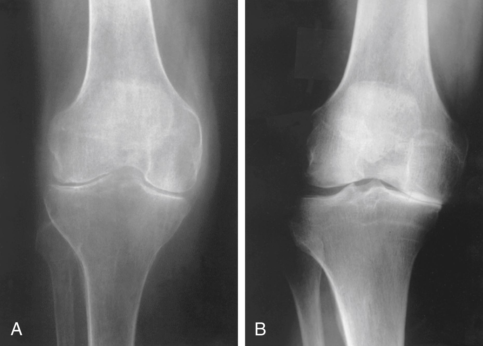 FIGURE 243-5, Radiographs of the knees in the two most common forms of arthritis: rheumatoid arthritis and osteoarthritis.