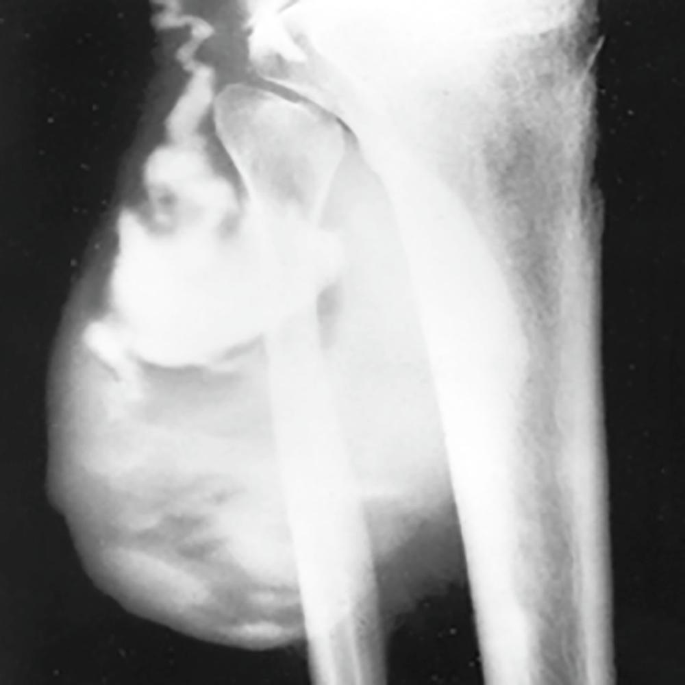 E-FIGURE 243-3, Arthrogram with a radiocontrast agent injected into the knee.