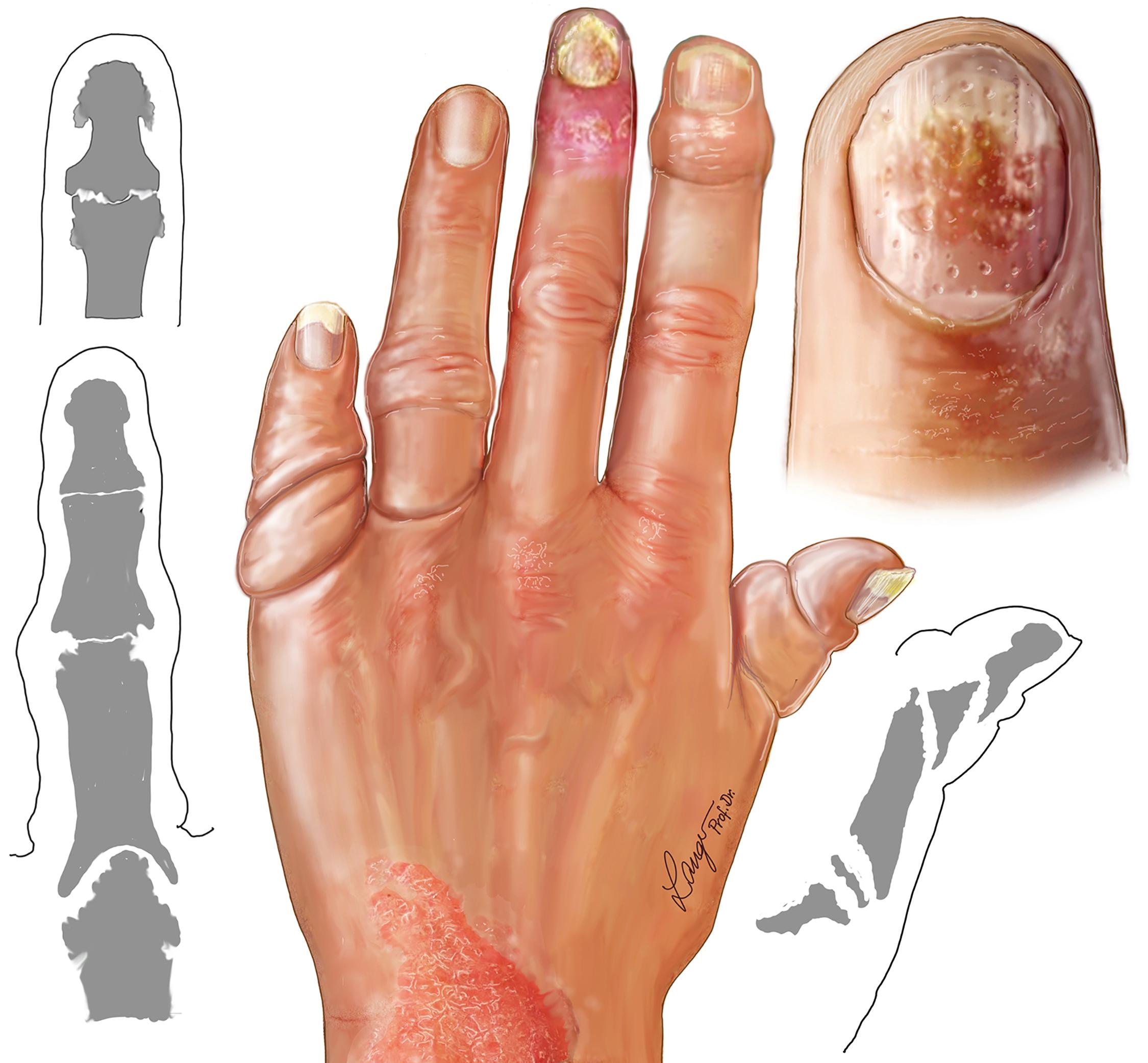 Fig. 55.1, Typical appearance of a psoriatic hand that includes the psoriatic skin rush, pitting nail deformity, joint destruction with significant bone loss (cup-in-pencil deformity), and shortening of the fingers (opera glass deformity).