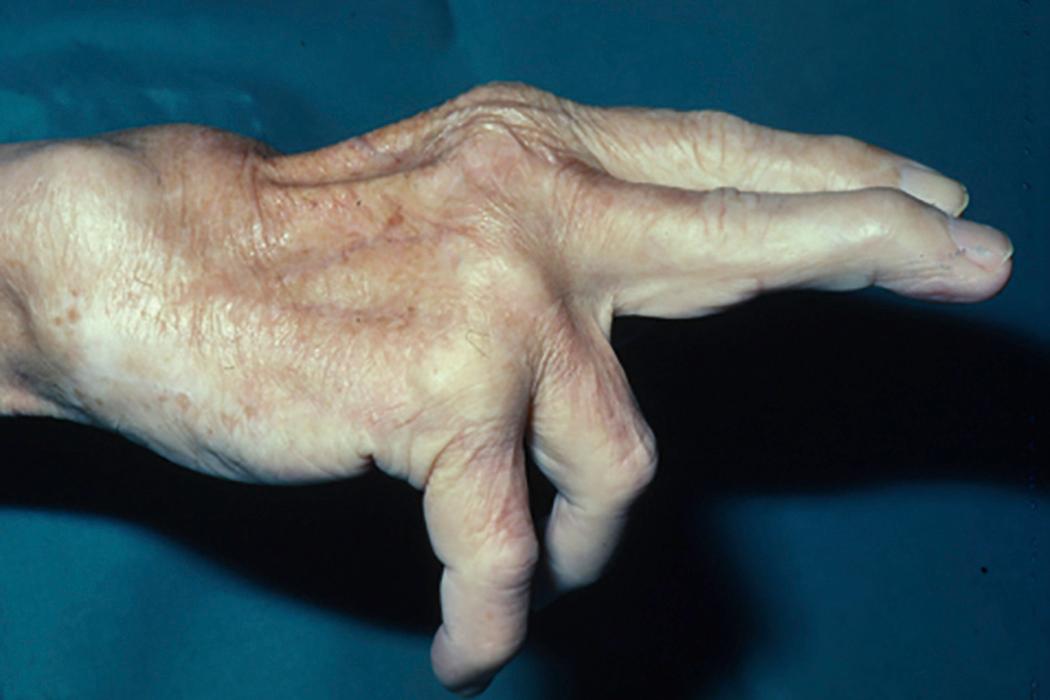 Fig. 55.11, Typical appearance of tendon ruptures to the small and ring fingers due to attrition of tendons over the ulnar wrist.