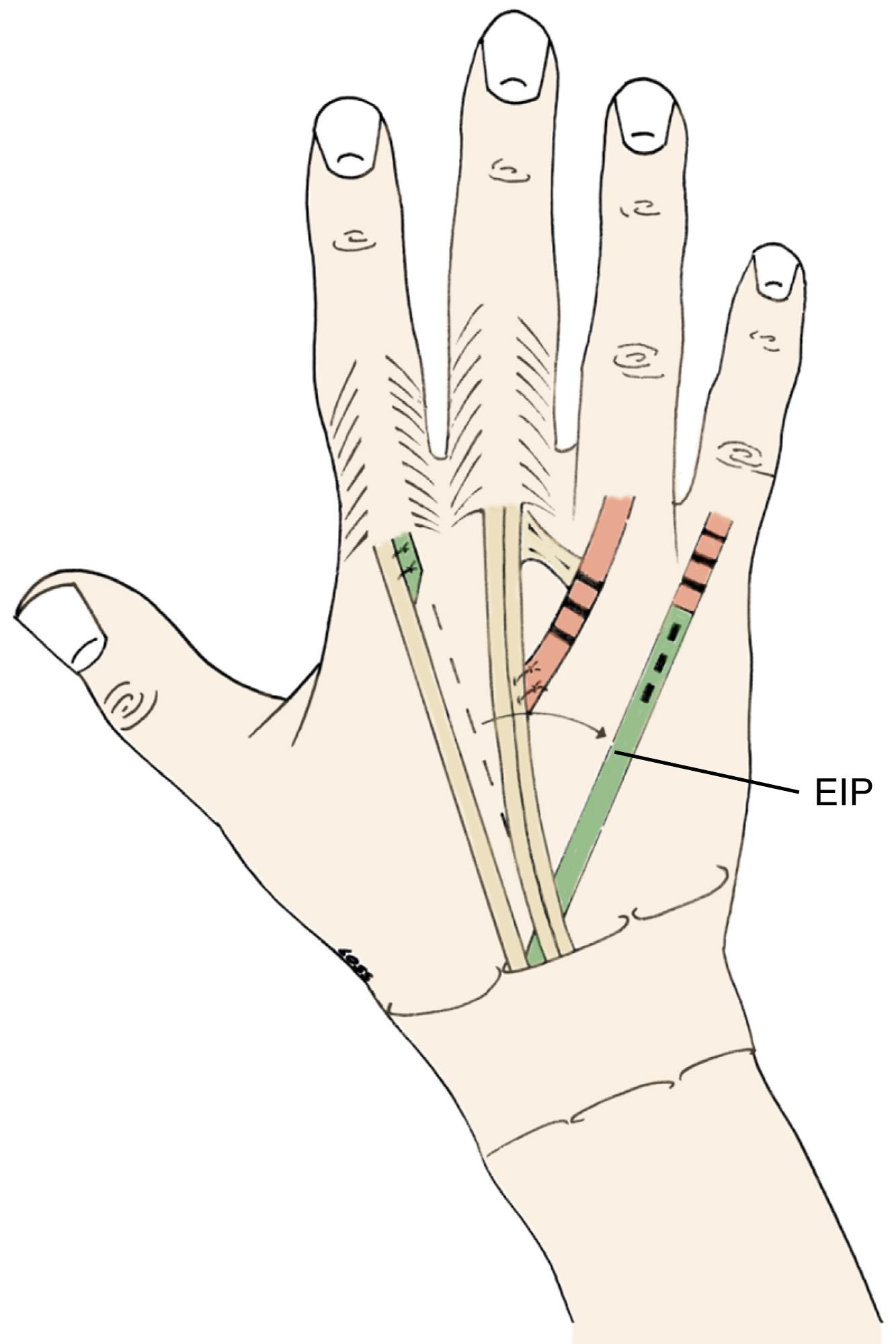 Fig. 55.12, Restoration of little and ring finger extension by end-to-side suture technique of the EDC 4 to EDC 3 and EIP transfer to EDQ.