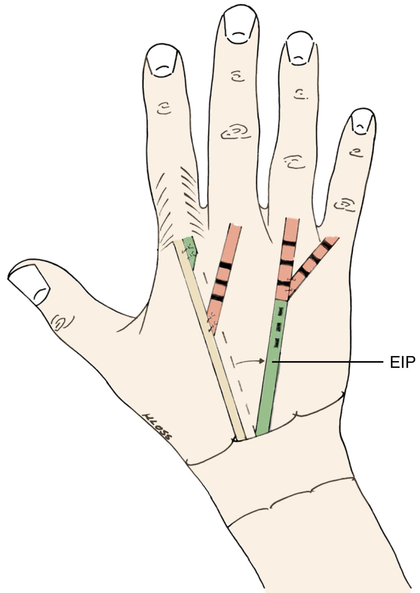 Fig. 55.13, Restoration of little, ring and middle finger extension by end-to-side suture technique of the EDC 3 to EDC 2 and EIP transfer to EDQ/EDC 4/5 .