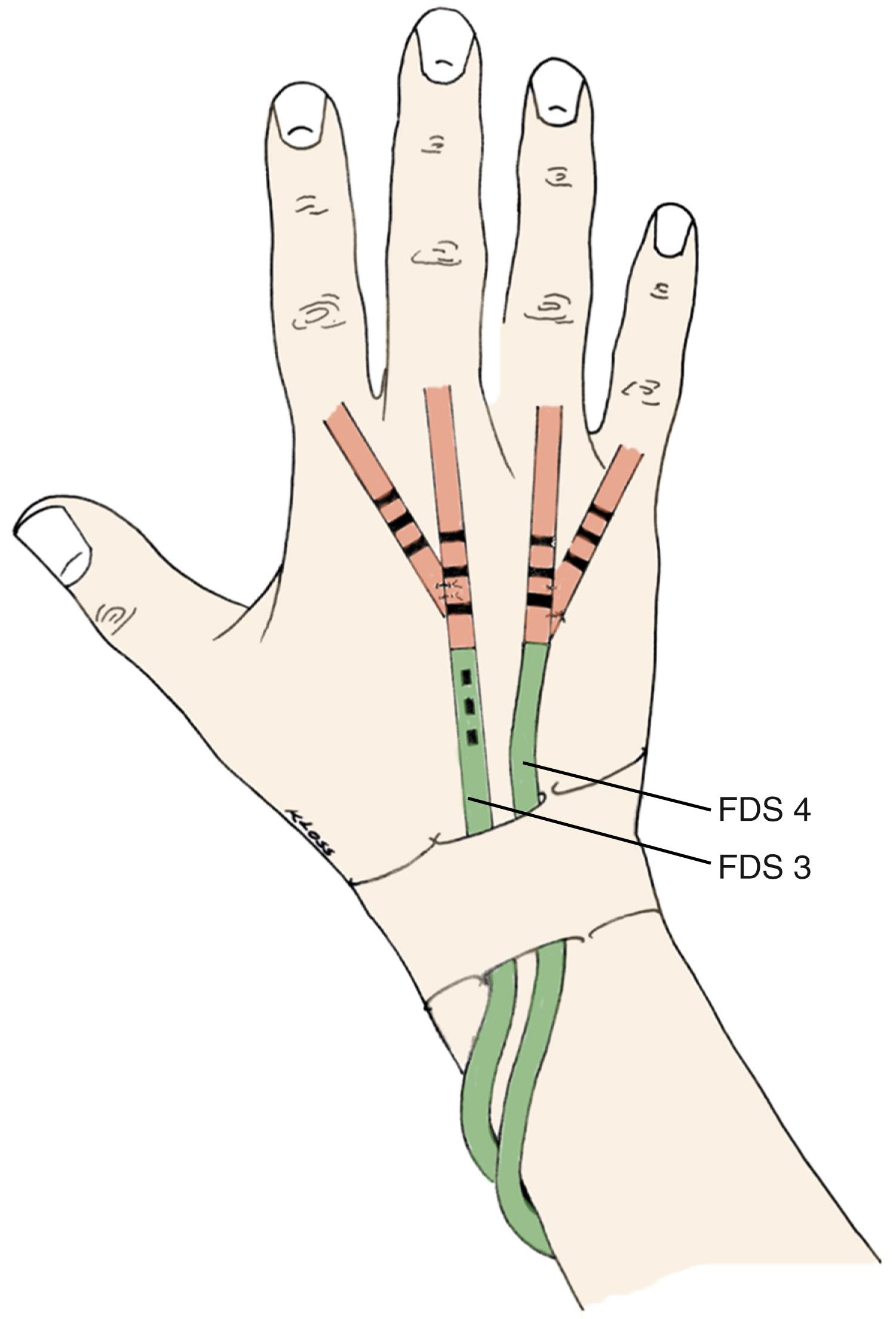 Fig. 55.14, Restoration of all long finger extensors by radially passed tendon transfer of the FDS 3 to index and middle finger and FDS 4 to ring and little finger extensor stumps.