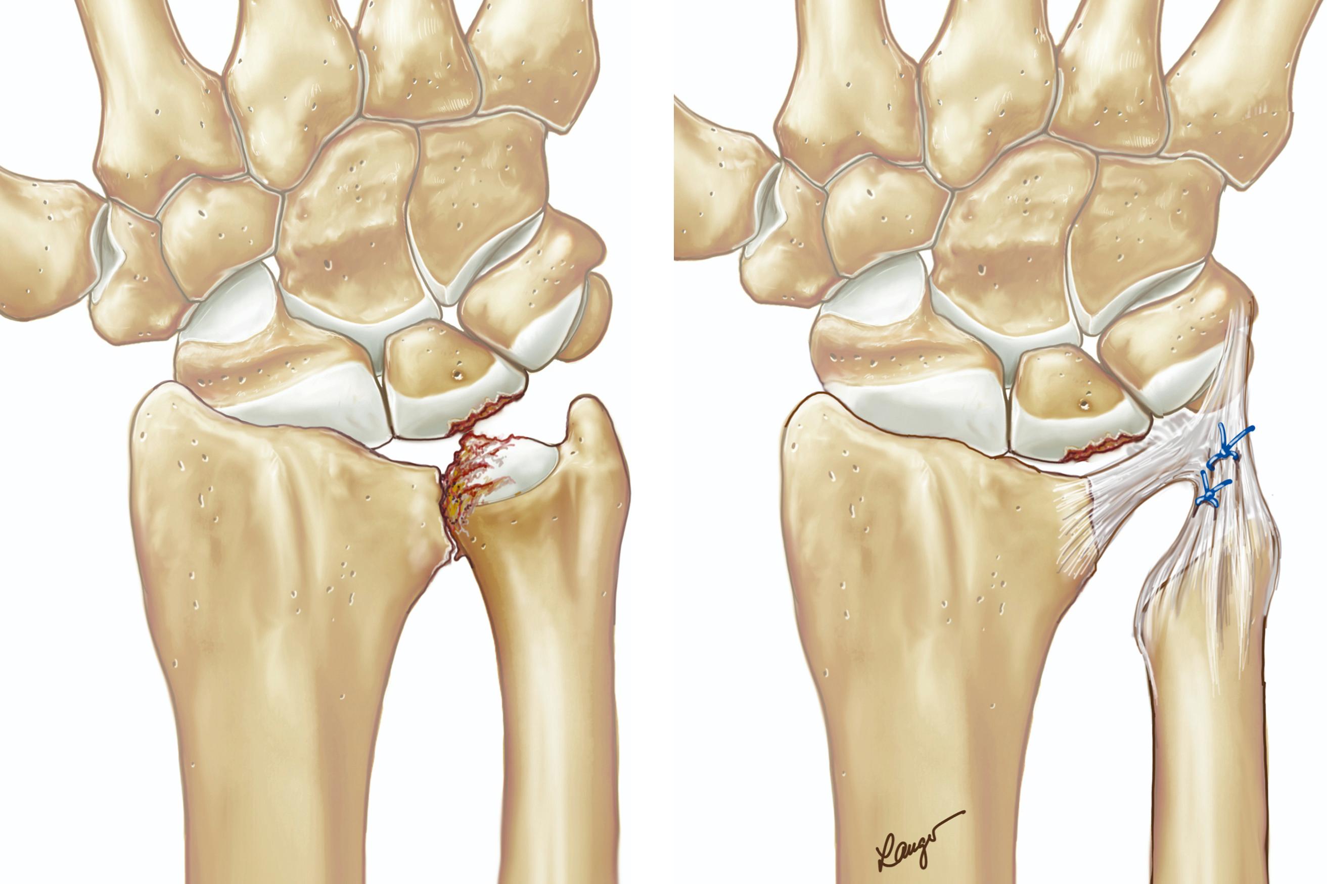 Fig. 55.15, Destruction of the distal radioulnar joint and ulnocarpal cartilage defect. The treatment consists of a distal ulna resection with stabilization of the ulna stump through tight suturing of the capsular tissue around the distal ulna stump.