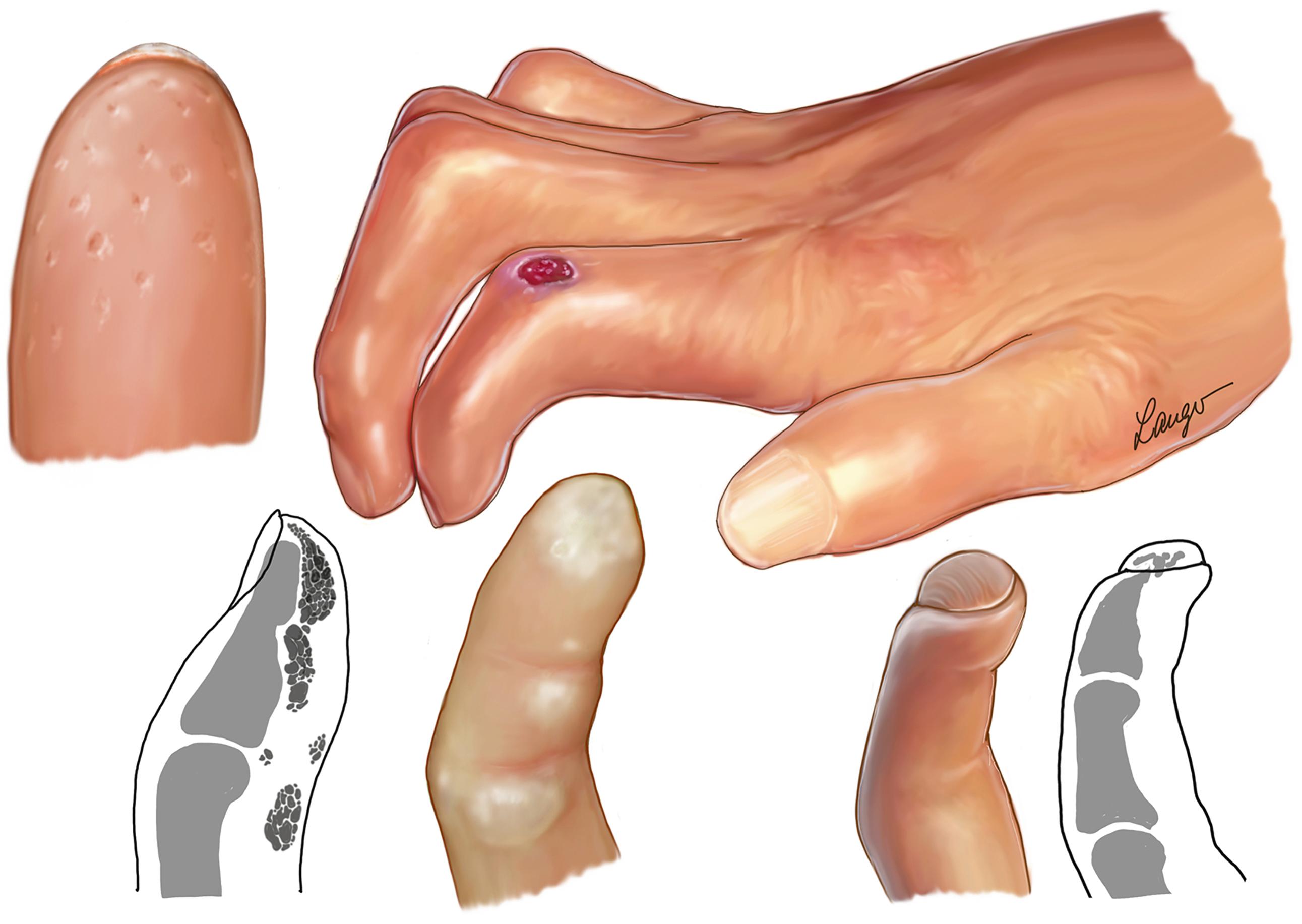 Fig. 55.2, Appearance of the hand in systemic sclerosis (SSc) with skin and subcutaneous thickening, contracture, and skin ulcers.