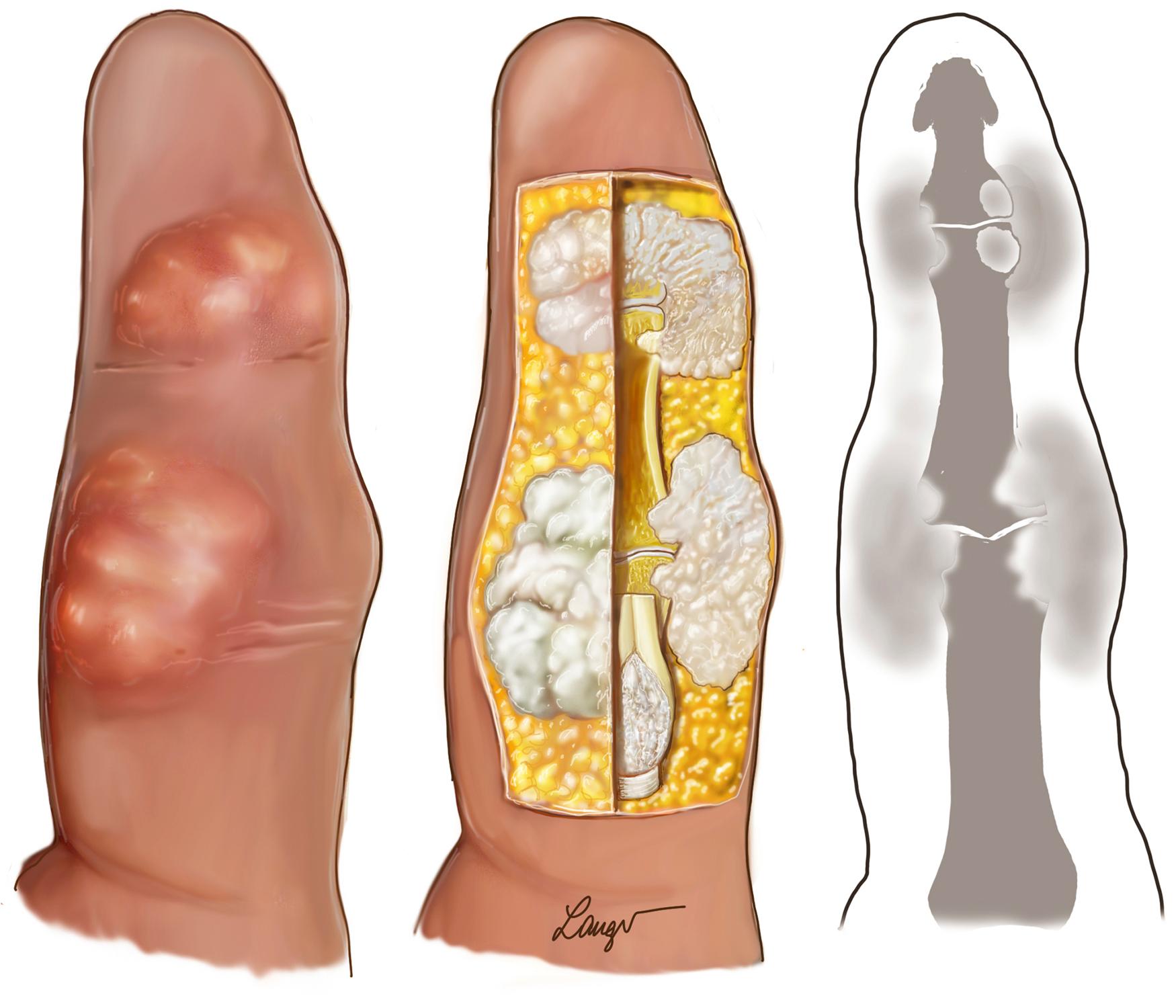 Fig. 55.3, Gout fingers with tophi and periarticular bone resorption.