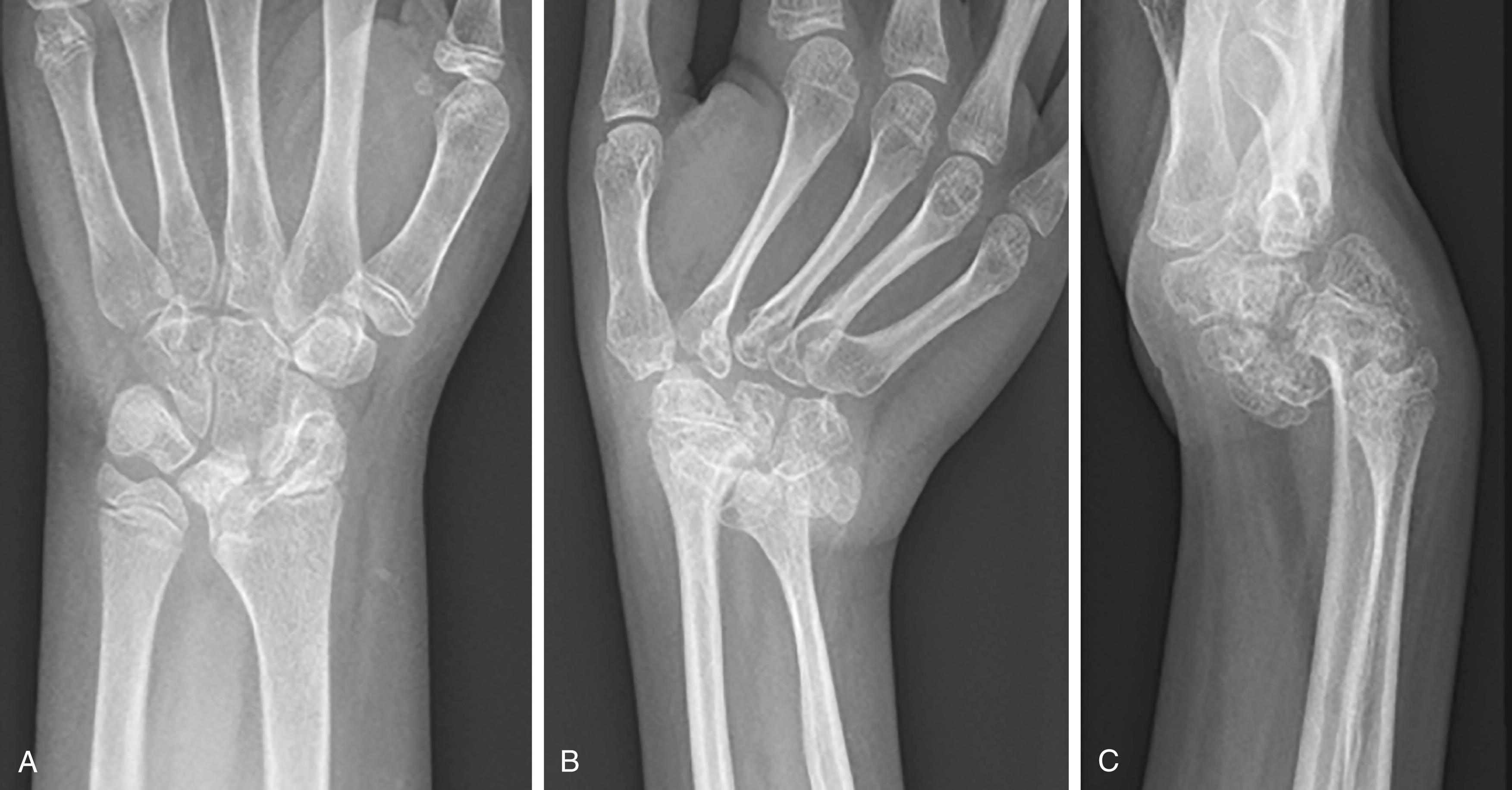 Fig. 55.5, Classic radiographic appearance of wrist involvement in juvenile rheumatoid arthritis. A, Ankylosing type. B and C, Unstable resorbing type of destruction.