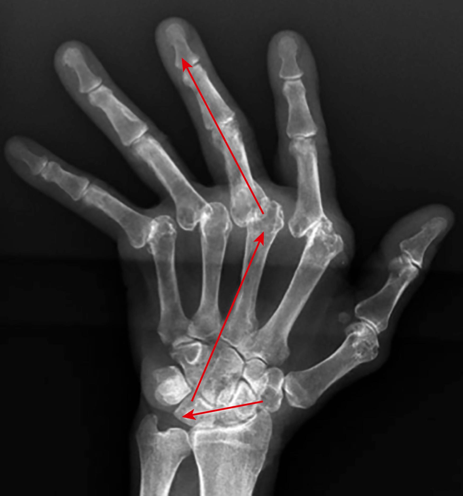 Fig. 55.6, The pattern of the so-called chain reaction according to Shapiro. The weakening of the radiocarpal ligaments provokes a carpal supination and ulnar translation, the metacarpals deviate radially, and consequently the MCP joints deviate to the ulnar side.