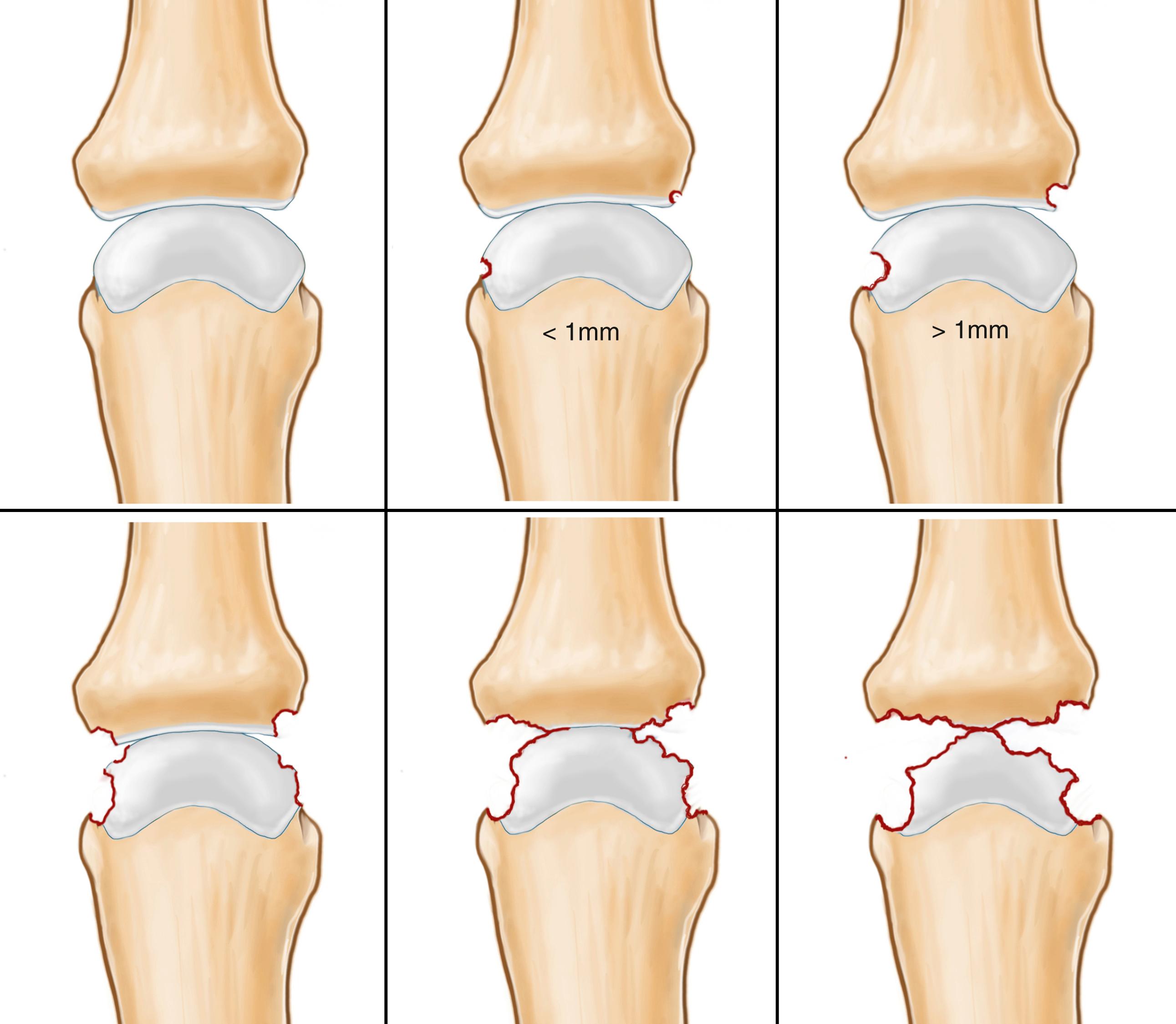 Fig. 55.7, Staging of rheumatoid disease in conventional x-rays according to Larson, Dale, Eek (LDE) classification. Grade 0 to grade 5. For explanation, see Table 55.2 .