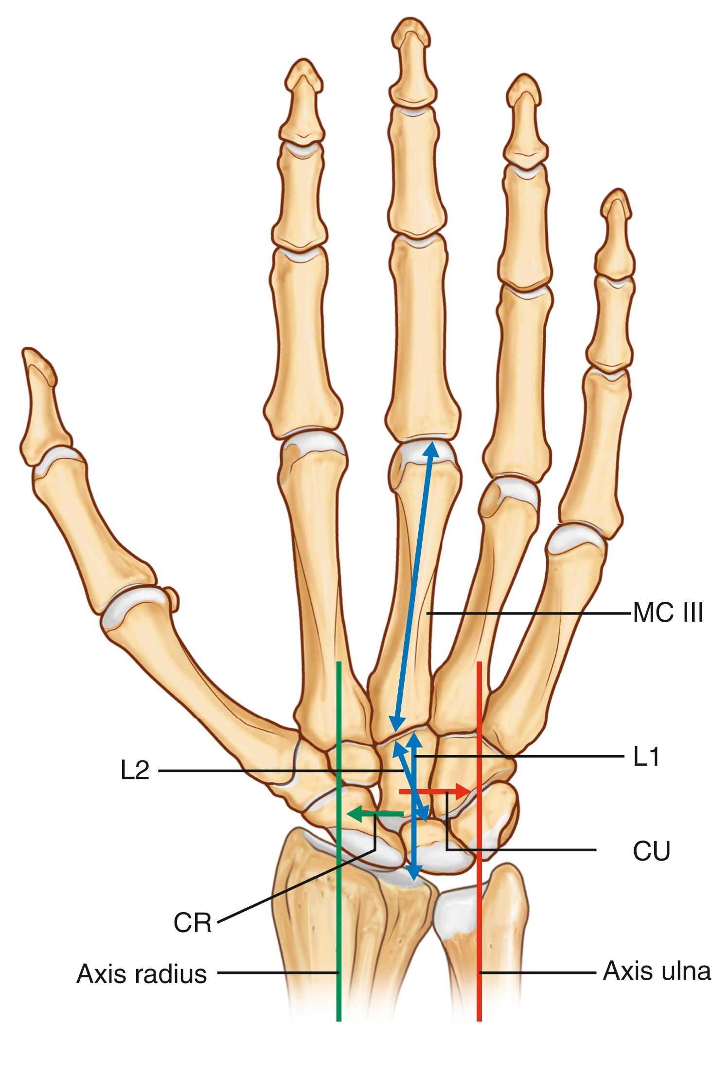 Fig. 55.8, Most important carpal indices in rheumatoid wrists. Carpal height ratio (CHR): MC III/L1; normal value: 0.51 to 0.57; Alternative CHR: L2/L1; Normal value: 0.62 to 0.66; carpal translation index: CU/MC III; normal value: 0.27 to 0.33; ulnar carpal translation: CR/MC III; normal value: 0.07 to 0.11.