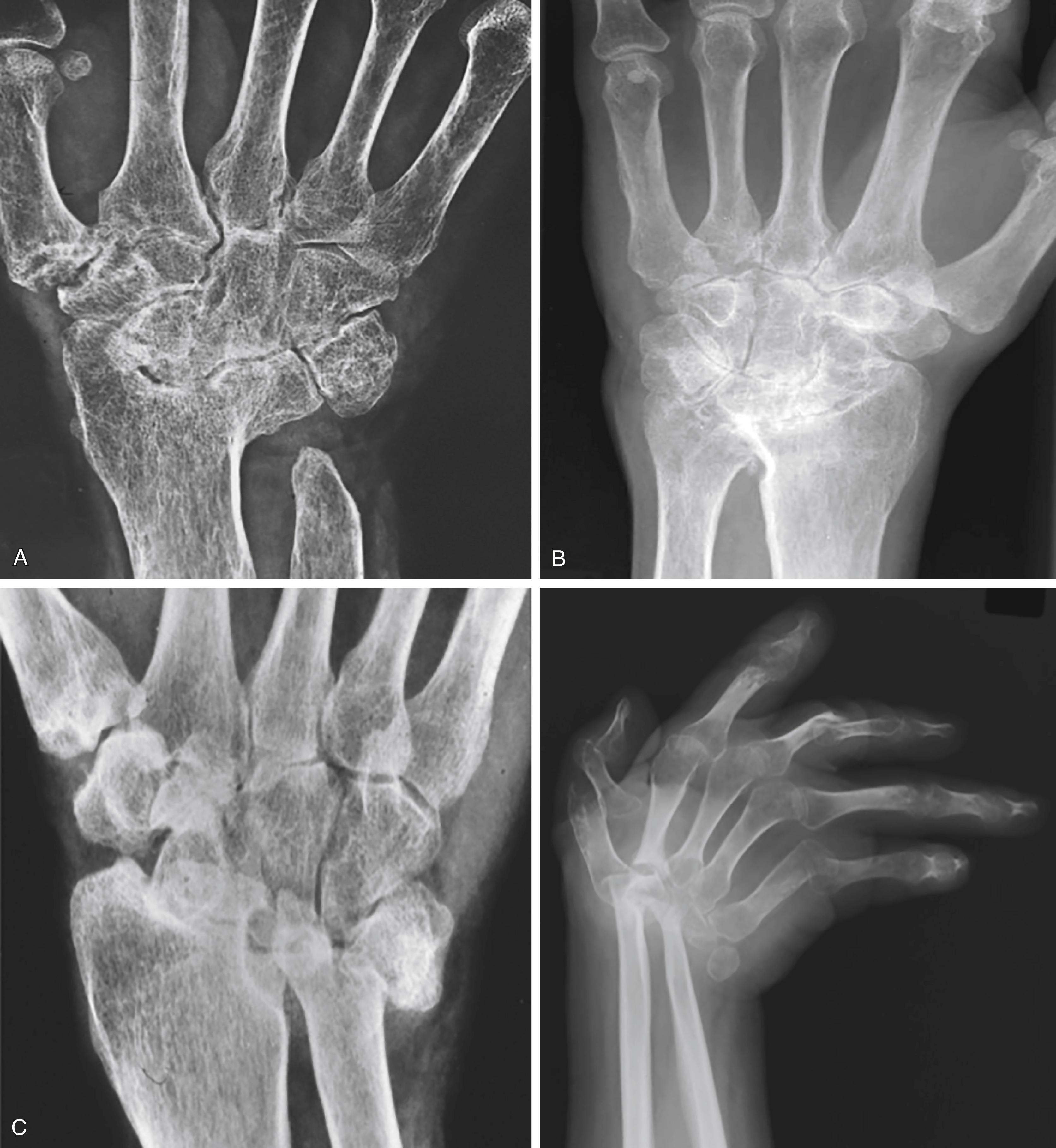 Fig. 55.9, Classification system of the rheumatoid wrist according to Simmen based on follow-up radiographs. A, Type I wrist with spontaneous fusion of the carpal bones (ankylosing type). B, Type II wrist with bone involvement resembling osteoarthritic changes. C, Type III disintegrative destruction of the carpal bones; type IIIa ligamentous unstable and type IIIb bony destruction (mutilans type).